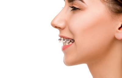 Magical Orthodontic Appliances: The Key to Confidence and Happiness